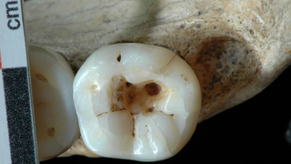 Imagen: Primera mandĂbula a la que se le retiraron las caries. CC// Stefano Benazzi
